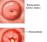 Hroniska dzemdes kakla iekaisuma cēloņi un ārstēšana