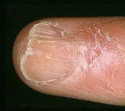 Причини за дистрофия на ноктите и методи на лечение