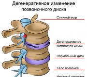 Osteochondrose-Behandlung, Symptome, Arten, vorbeugende Maßnahmen, Arten von Osteochondrose